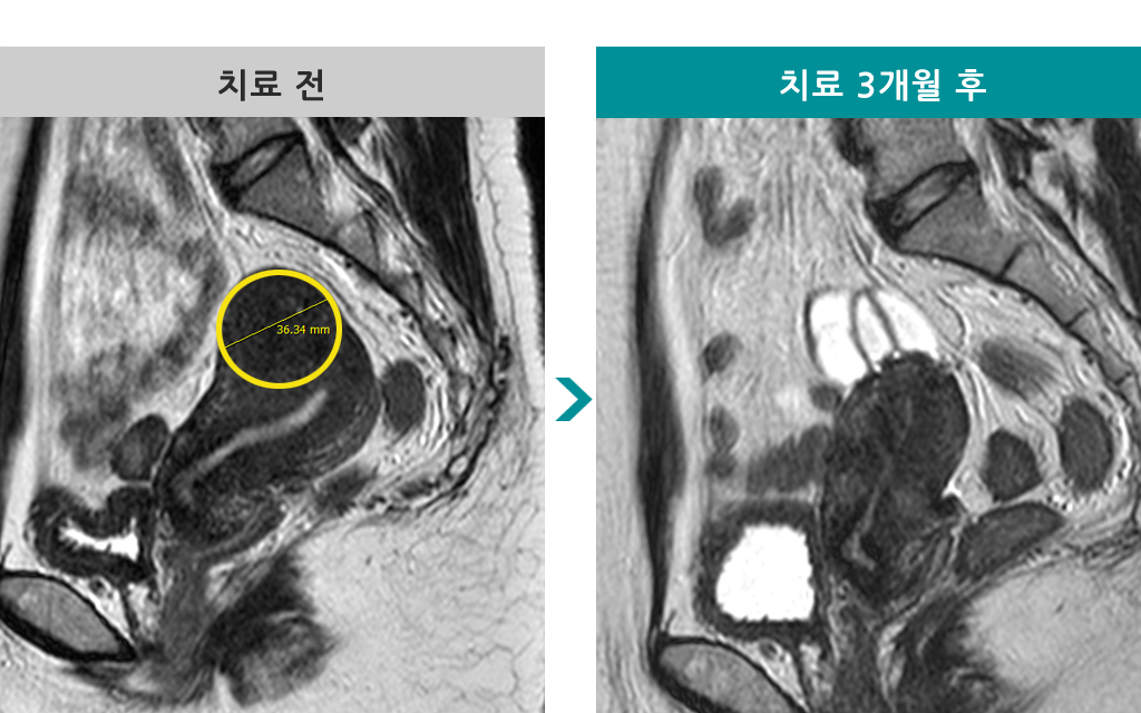 36세_00845389_단일공선근종절제술.jpg