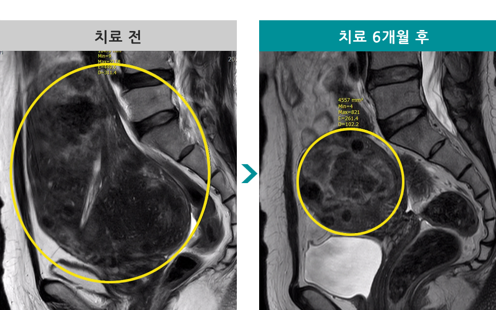 51세자궁근종자궁선근증색전술.jpg