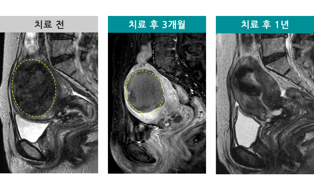 008395801하이푸1년경과.jpg