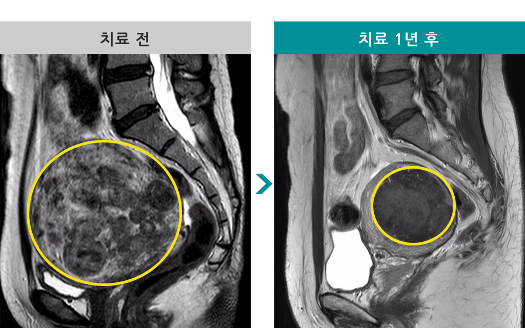 38세00838137평활근종증색전술.jpg