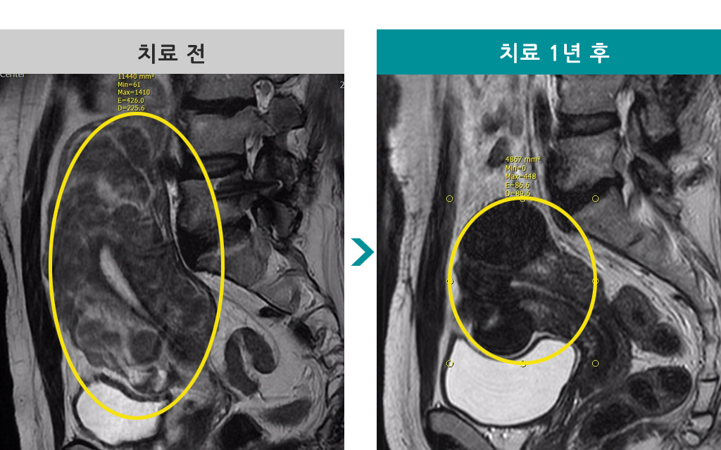 34세00823435색전술.jpg