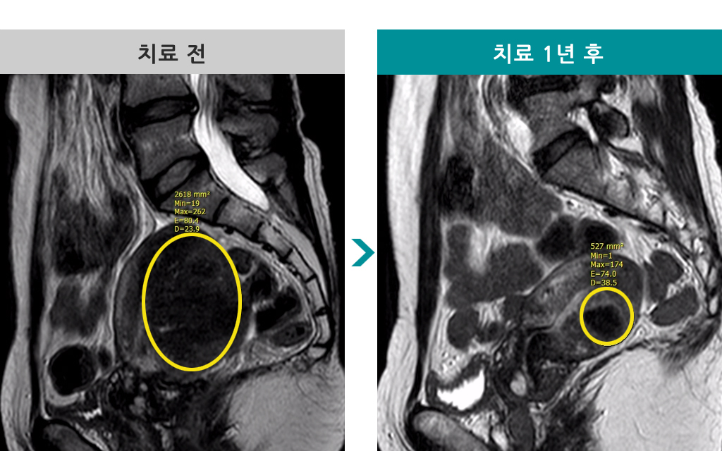 44세00838575선근증색전술.jpg