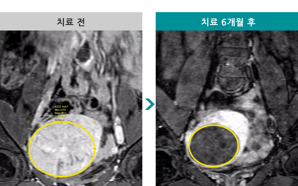 44세00843902자궁근종색전술.jpg