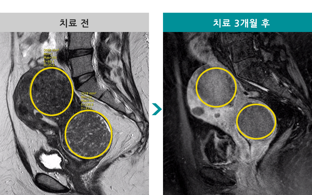 41세00846716경부근종선근증색전술.jpg