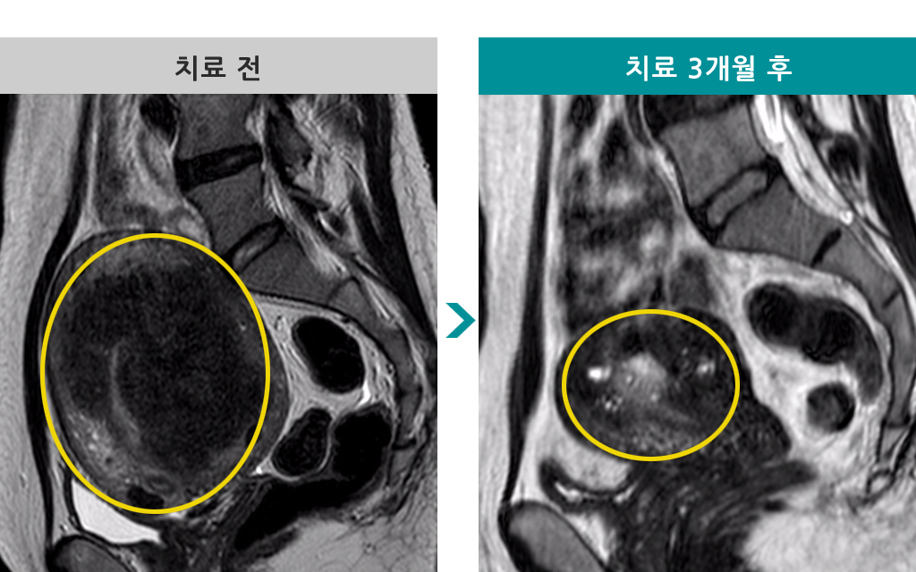 34세자궁선근증00847378.jpg