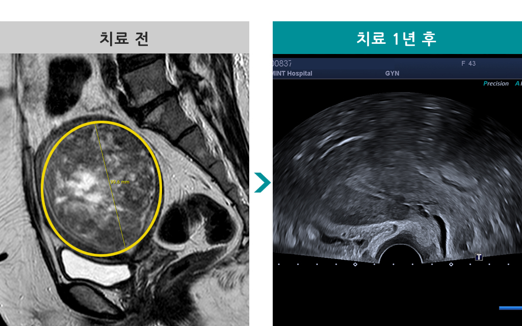 42세자궁근종절제00837898.jpg