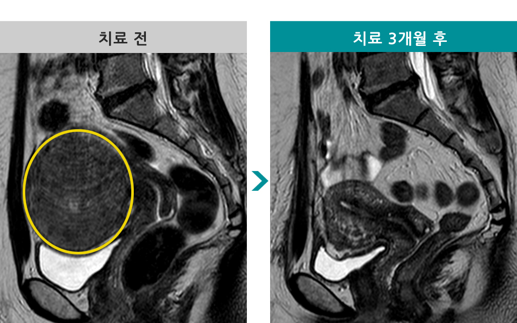 38세00846223근종절제술.jpg