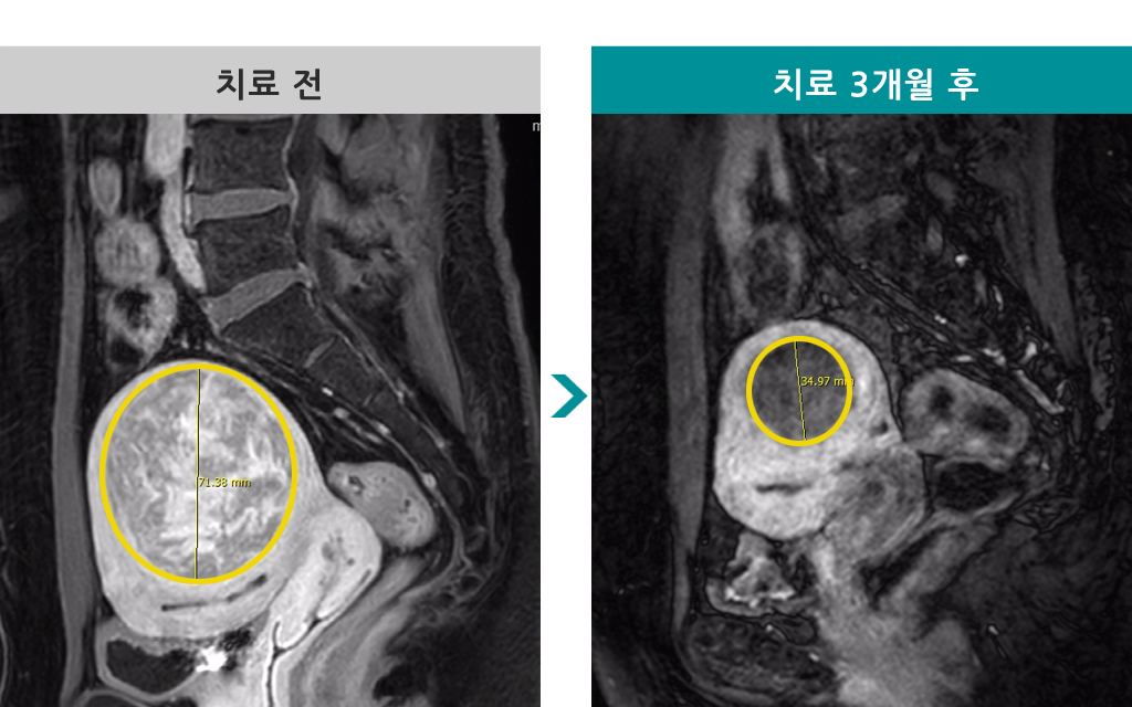 49세00843399색전술.jpg