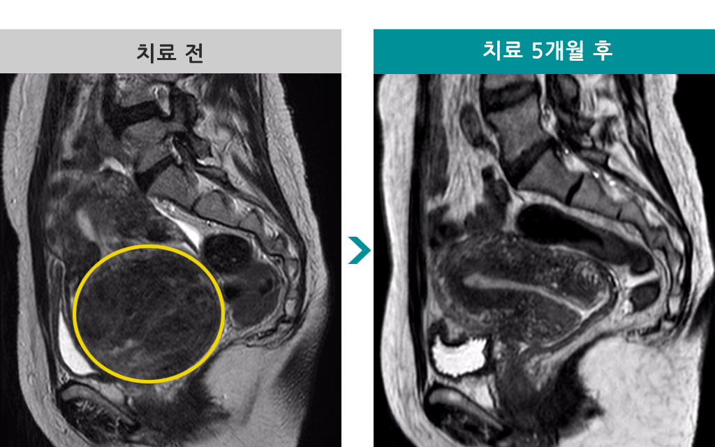 48세00837348색전술자궁경.jpg