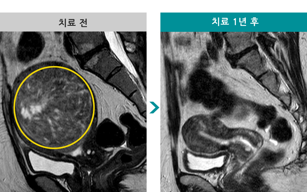 00837898색전술후자궁경.jpg