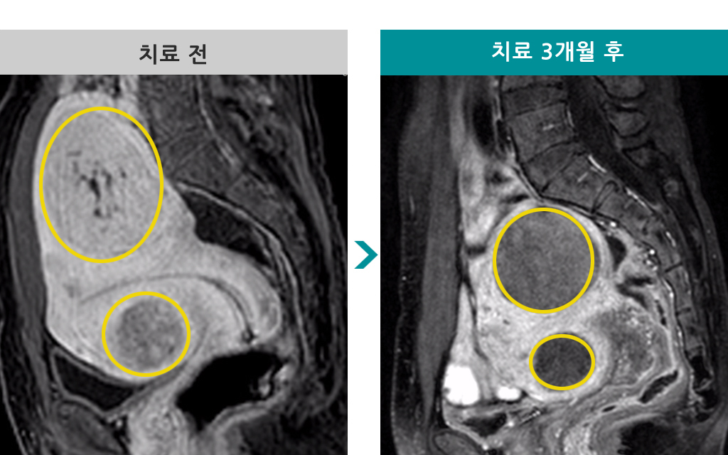 53세00847728색전술.jpg