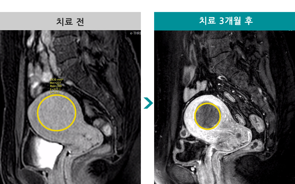 43세이선경색전술.jpg